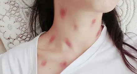 为什么女生的脖子上经常会有红印？