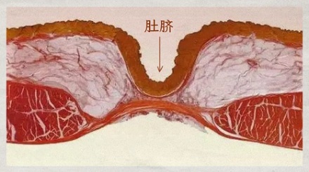 法医下刀时，为什么要绕开肚脐眼？