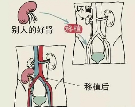 你了解肾脏移植手术吗？