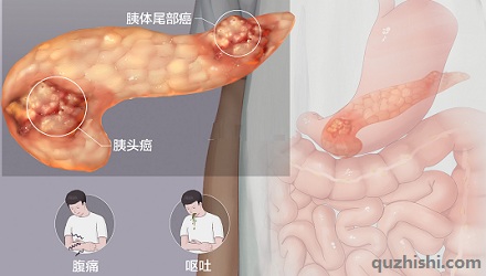 哪些人群最宜罹患「胰腺癌」？