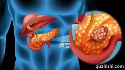 哪些人群最宜罹患「胰腺癌」？